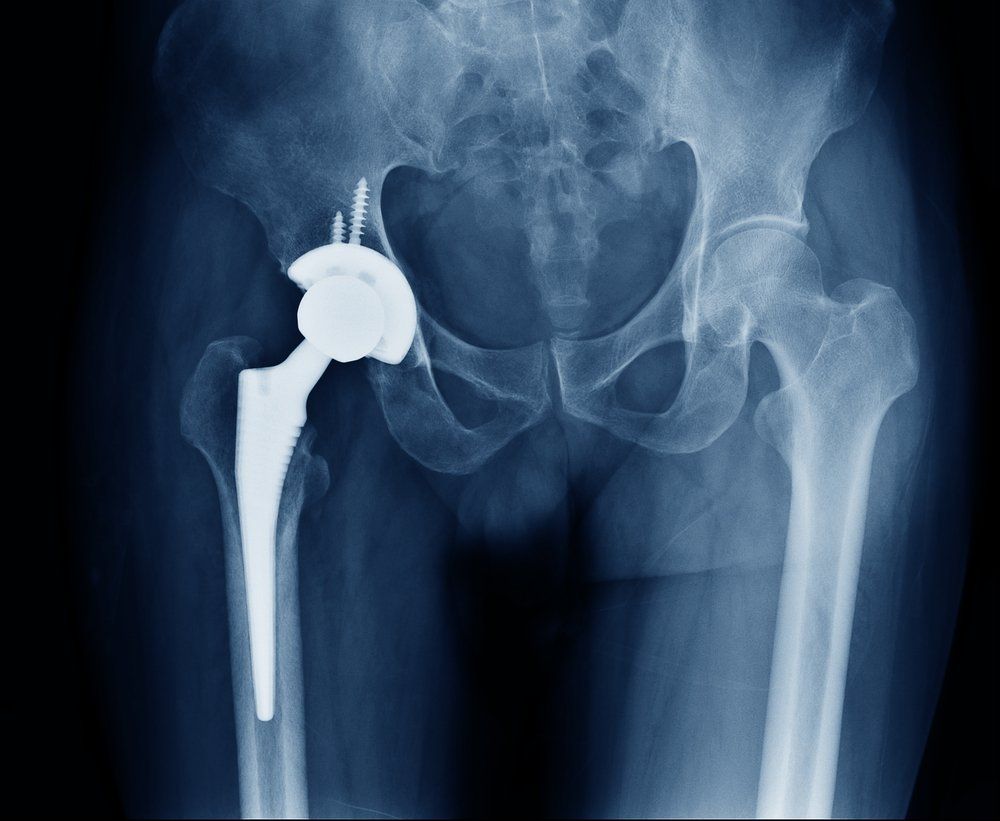 total-hip-replacement-procedures-in-adelaide