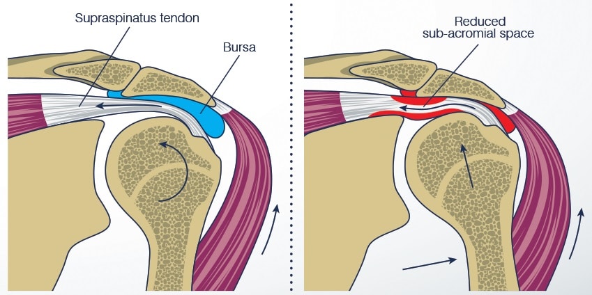 Subakromial Sıkışma (impingement)