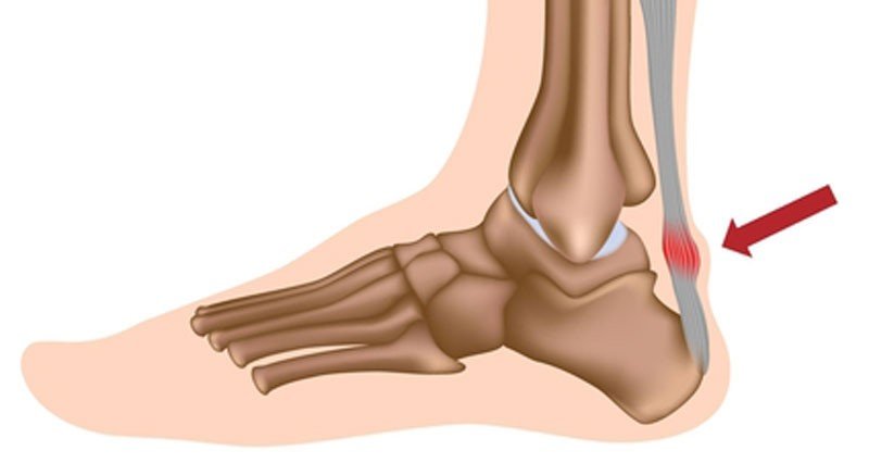 Aşil Tendiniti ve Aşil Tendon Yaralanmaları